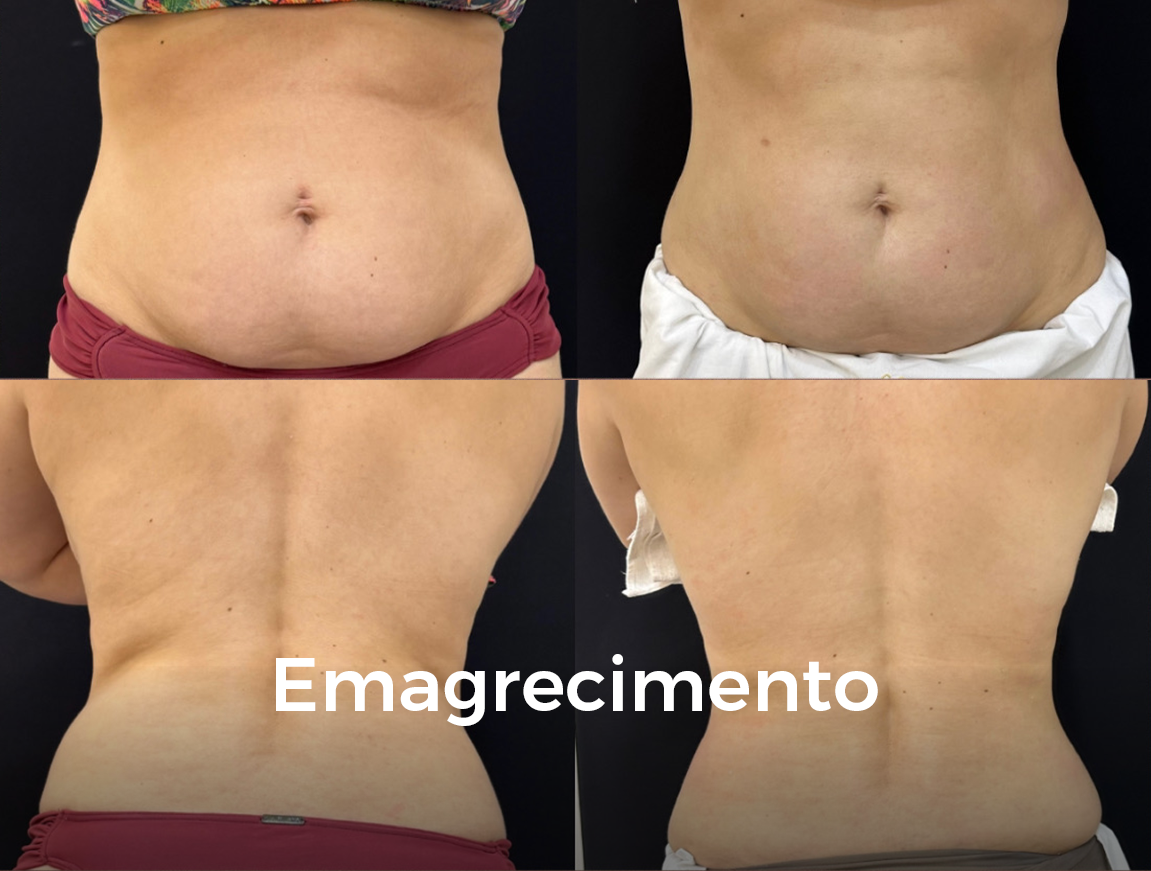 Emagrecimento