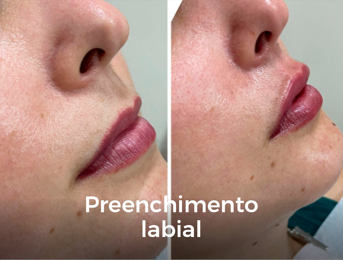 Preenchimento Labial