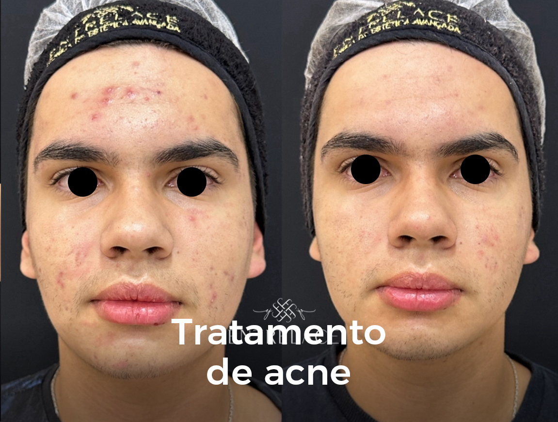 acne