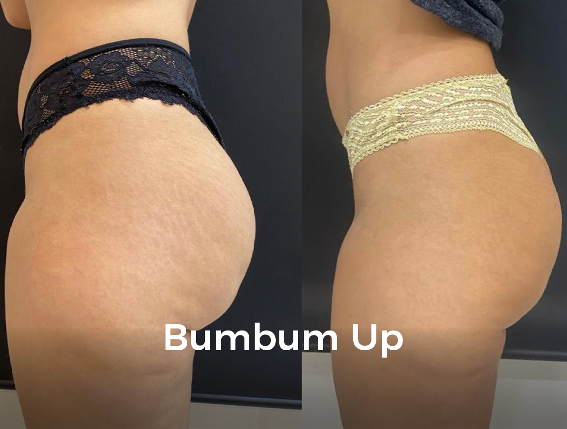 bumbum up
