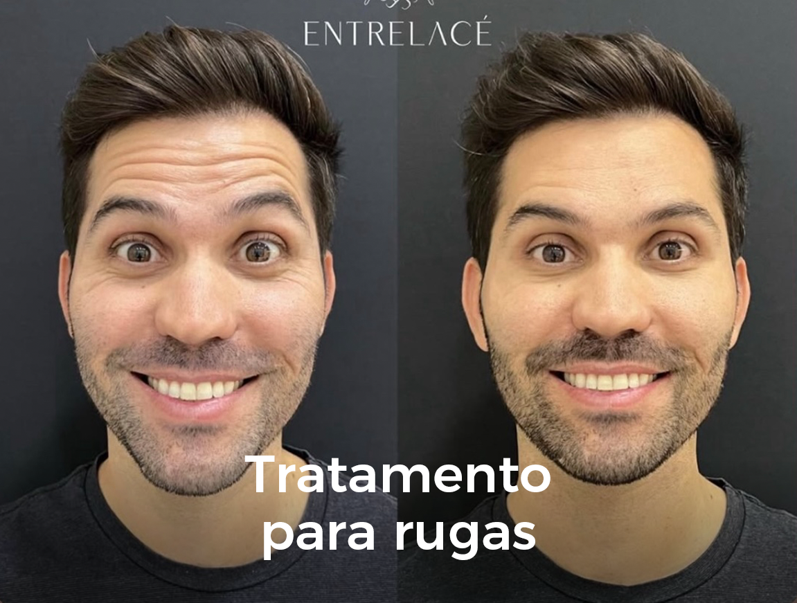 rugas