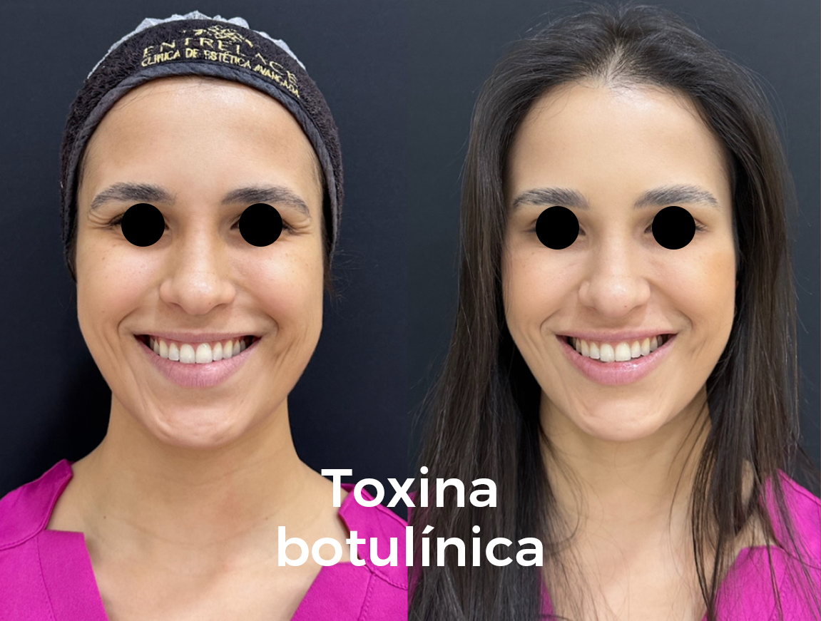 Botox 2